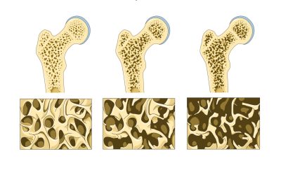 Les bienfaits de l’activité physique sur l’ostéoporose